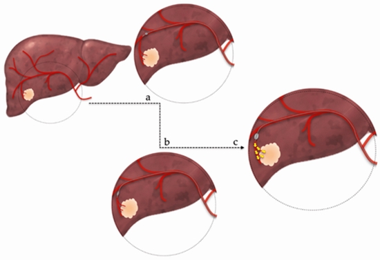 Unresectable Hepatocellular Carcinoma {faces}